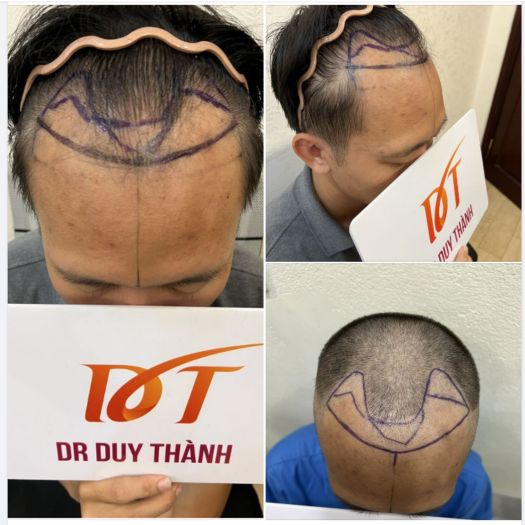 CHUẨN BỊ CẤY 1600 NANG TÓC, KHÁCH NAM 30 TUỔI