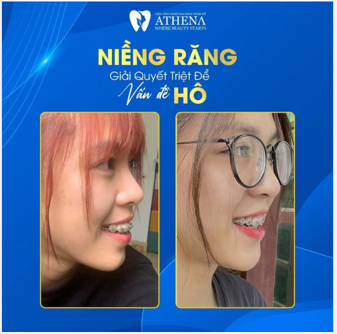 NIỀNG RĂNG - GIẢI QUYẾT VẤN ĐỀ HÔ
