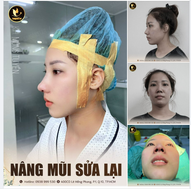 KẾT QUẢ CA NÂNG MŨI SỬA LẠI | KH: MỘNG TUYỀN