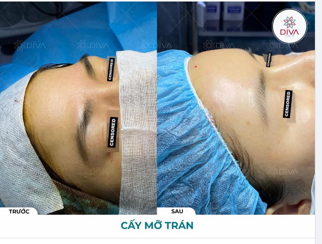 THẨM MỸ CẤY MỠ COLEMAN TRÁN SAU THỰC HIỆN XONG CÓ ĐẸP LIỀN KHÔNG?