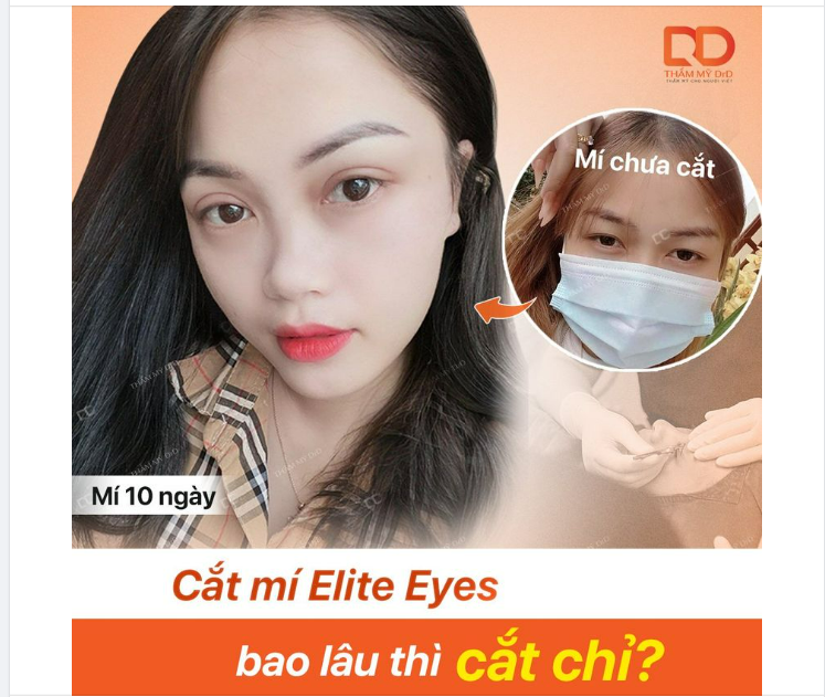 CẮT MÍ ELITE EYES BAO LÂU THÌ CẮT CHỈ?