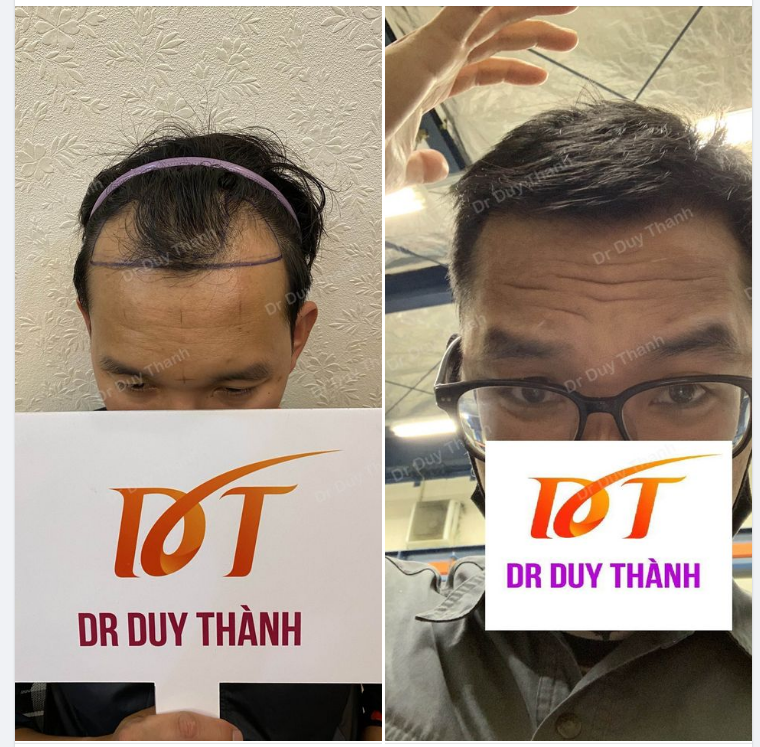 KẾT QUẢ SAU CẤY TÓC 3 THÁNG 21 NGÀY ( BẠN NAM CẤY 1600 NANG)