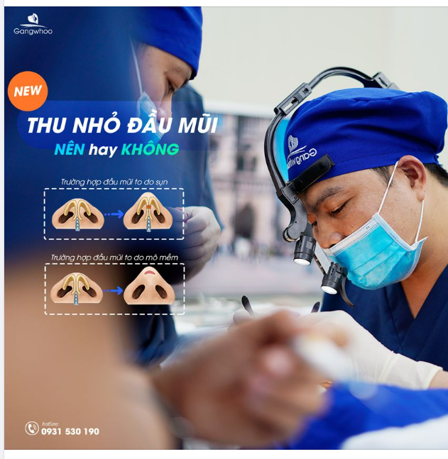 THU NHỎ ĐẦU MŨI, NÊN HAY KHÔNG?