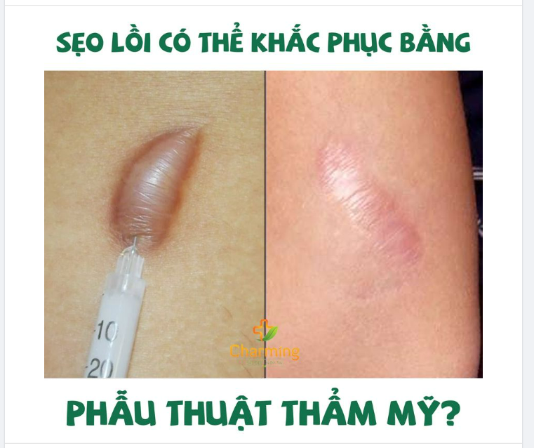 SẸO LỒI CÓ THỂ KHẮC PHỤC BẰNG PHẪU THUẬT THẨM MỸ?