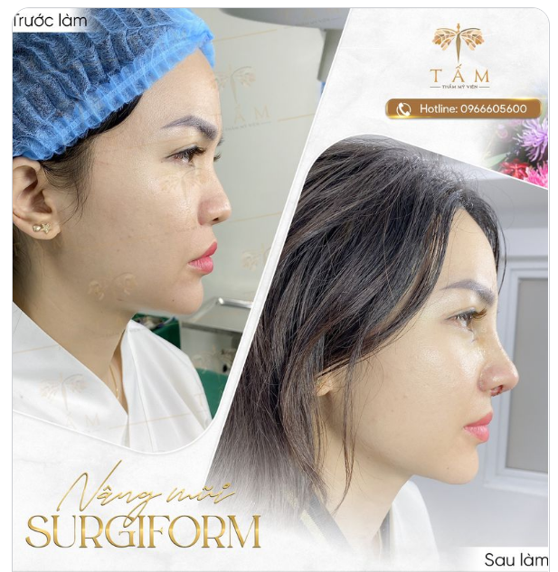 Nâng mũi Surgiform tái chỉnh hình sống mũi thiếu độ cao, đầu mũi cụp