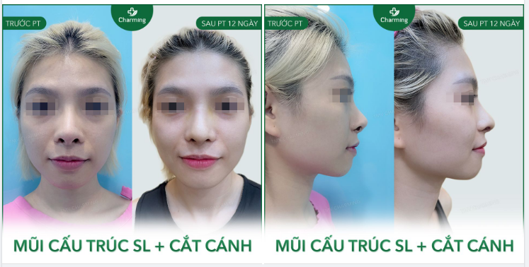 Phương pháp nâng mũi cấu trúc đúng là cứu tinh của những chiếc mũi đã từng qua một lần trùng tu nhưng lại không đạt được kết quả như ý.