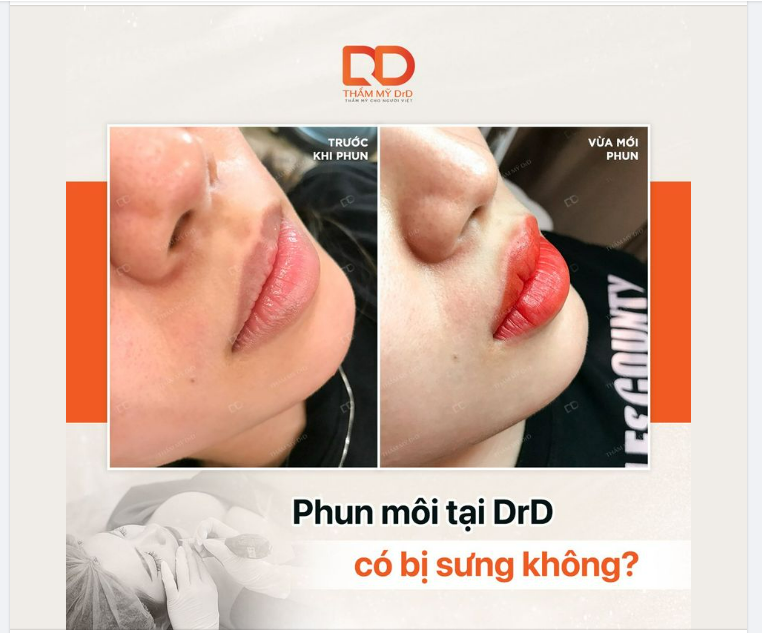 THẨM MỸ DrD PHUN MÔI KIỂU GÌ MÀ KHÔNG SƯNG VẬY?