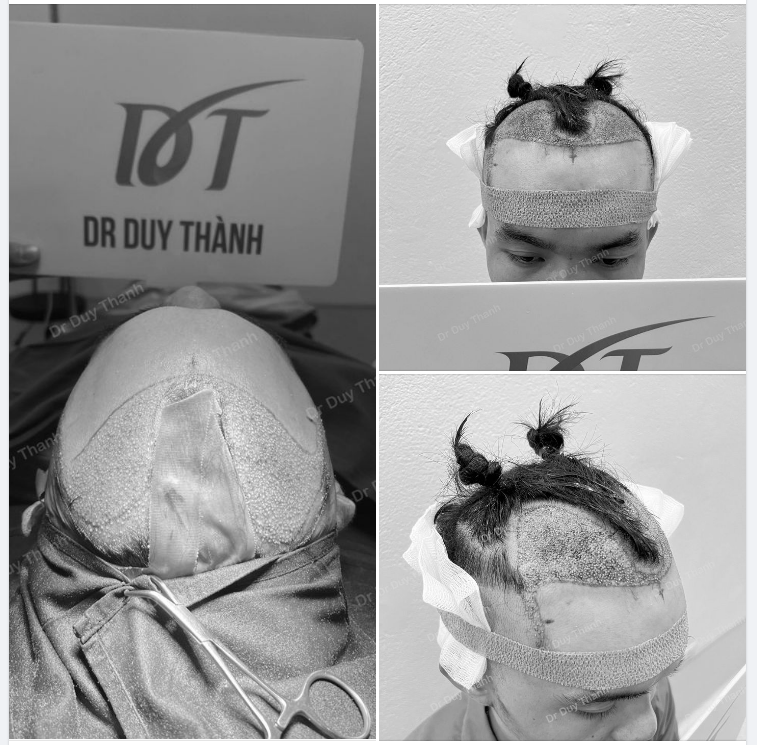 KẾT QUẢ NGAY SAU CẤY TÓC1800 NANG BOY HÀ ĐÔNG 29 TUỔI (ngày hôm trước)