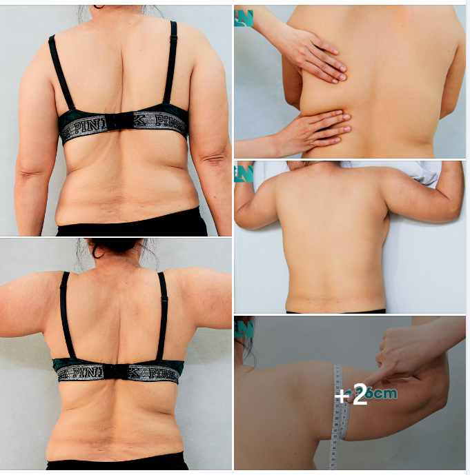  HÚT MỠ TẠO DÁNG THẨM MỸ VÙNG CÁNH TAY, LƯNG, NÁCH CHO CHỊ KH U60 ĐẾN TỪ AN GIANG, ÁP DỤNG BIỆN PHÁP GIẢM MỠ THỜI GIAN DÀI KHÔNG HIỆU QUẢ. 
