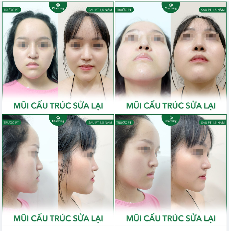 Mũi cũ của bạn khách này đã từng nâng nhưng bị lệch nhẹ, lại thêm phần sóng hơi quá lố một chút nên là khiến mũi hơi khoằm, trông như đang chúc xuống dưới.
