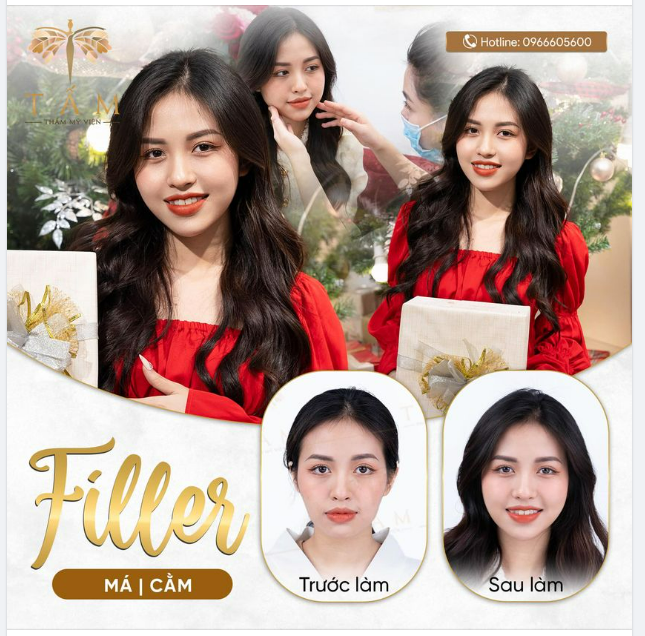 Combo Filler má, cằm đẹp ngay sau làm - chẳng lo bỏ lỡ thời điểm vàng làm đẹp đón giáng sinh.