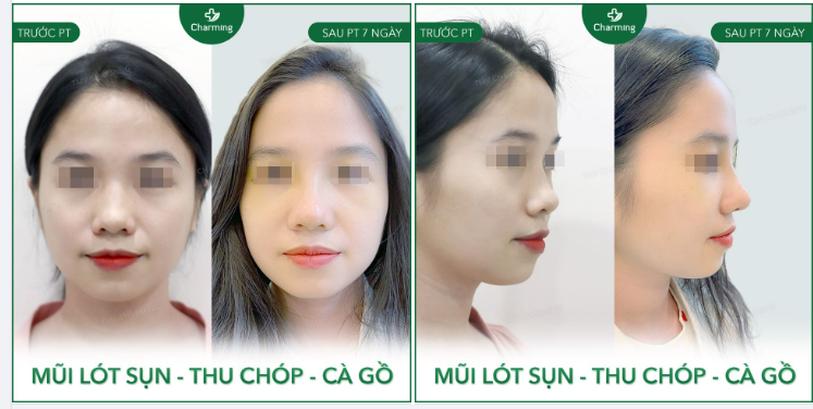 Nếu bình thường phương pháp lót sụn chiếm spotlight bởi ưu điểm làm hoàn thiện dáng mũi thì nay spotlight đó được nhường lại cho hai phẫu thuật thu chóp và cà gồ.