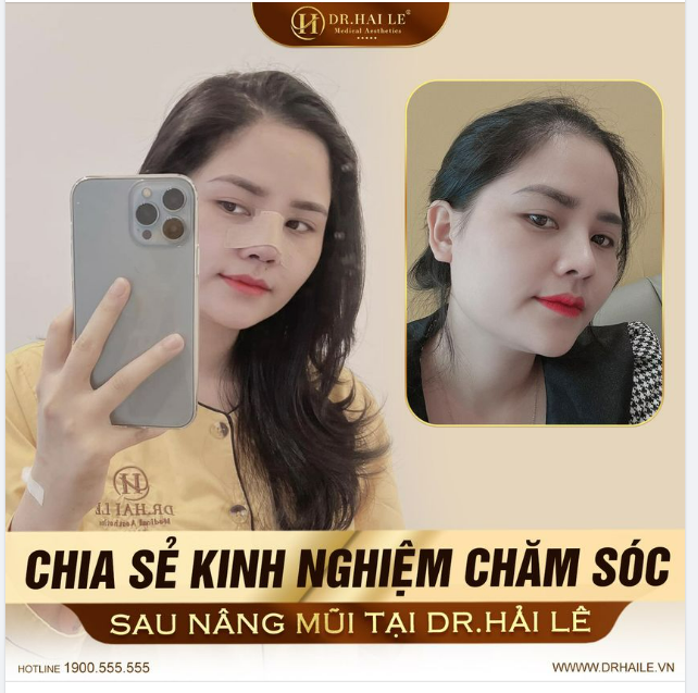 TẤt TẦn TẬt TỪ A Z Kinh NghiỆm ChĂm SÓc Sau NÂng MŨi 