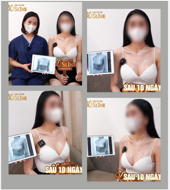 NGỰC XINH SAU 10 NGÀY ?