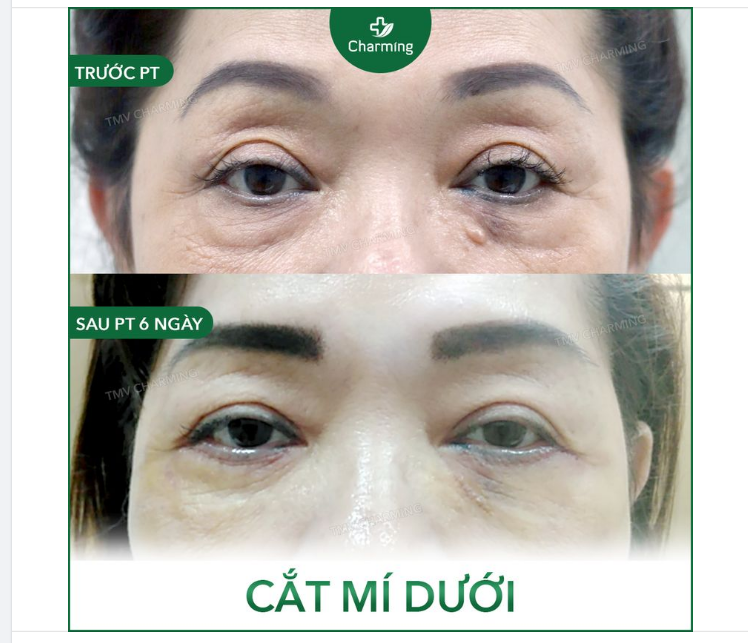 Ngoài việc cắt mí trên để có mắt hai mí thì chúng ta đôi lúc cũng cần “ngó” qua mí dưới xem có bọng mỡ mí dưới hay không.