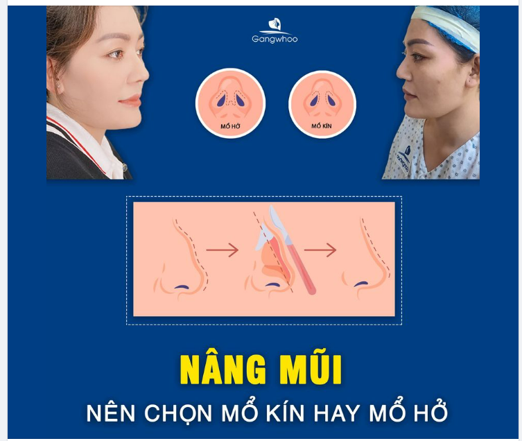 PHẪU THUẬT NÂNG MŨI TẠO ĐƯỜNG MỔ Ở ĐÂU?