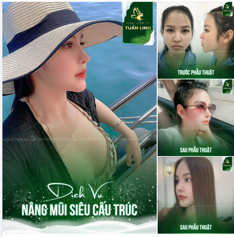MỘT DÁNG MŨI CAO XINH CHUẨN TỈ LỆ SẼ THAY ĐỔI KHUÔN MẶT BẠN NHƯ THẾ NÀO