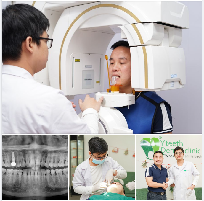 Anh Nam vừa hoàn thành quá trình phục hình Implant tại nha khoa Yteeth.
