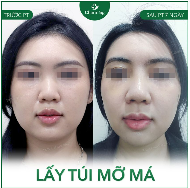 Nếu muốn tìm một khuôn mặt V-line thì nhiều bạn sẽ nghĩ ngay đến phẫu thuật độn cằm.