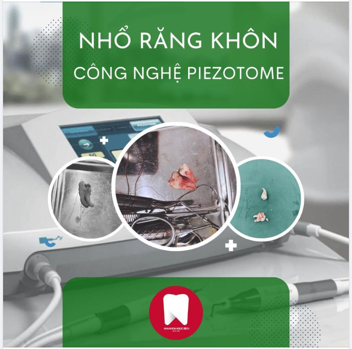 NHỔ RĂNG KHÔN KHÔNG ĐAU VỚI PIEZOTOME