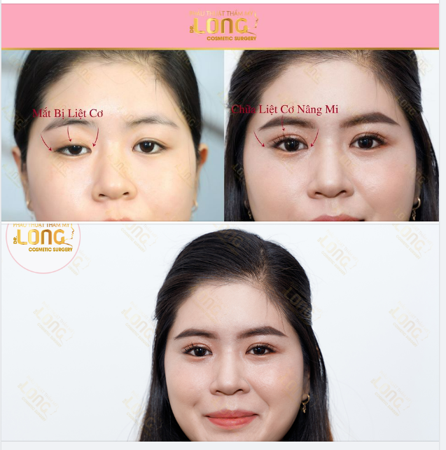 Cùng là đường cắt mí nhưng sao cắt mí tại PTTM Bác sĩ Long lại lạ đến thế!!!!