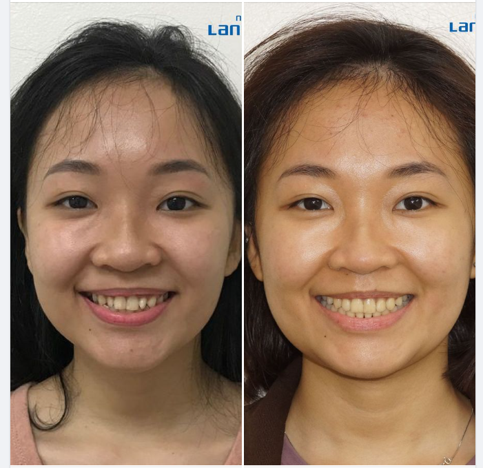 Muốn đẹp, muốn có kết quả, thì phải tìm bác sĩ giỏi để niềng cho bạn, chứ không phải là hãng Invisalign sẽ niềng cho bạn.