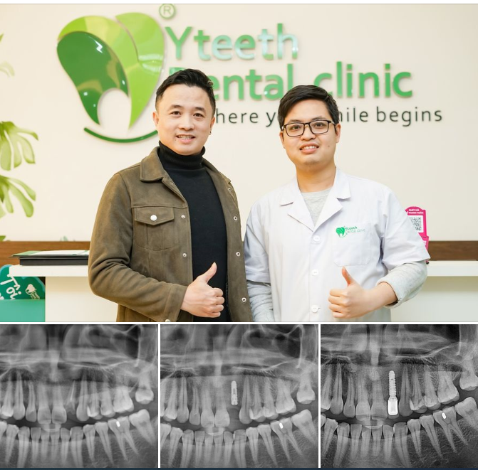 Phục hình Implant răng cửa và nụ cười của anh ấy đã tươi trở lại