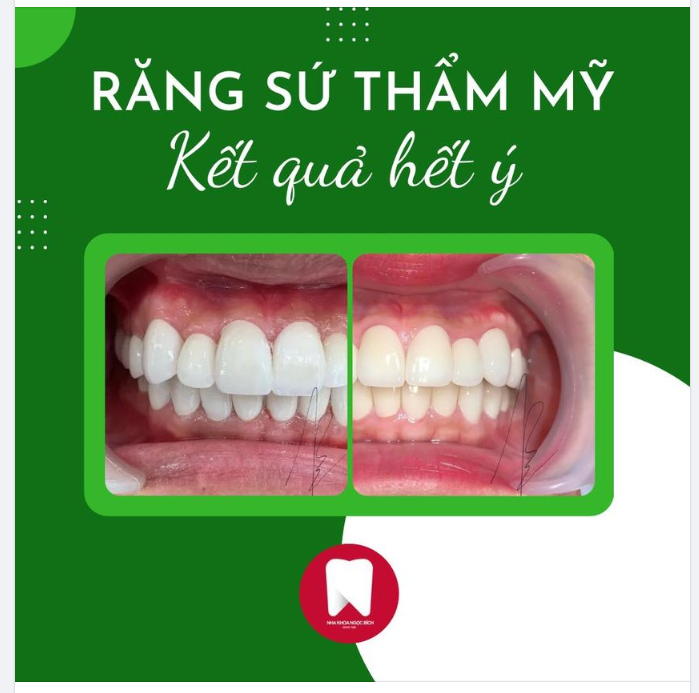 VÌ SAO NÊN LÀM RĂNG SỨ TẠI NHA KHOA NGỌC BÍCH