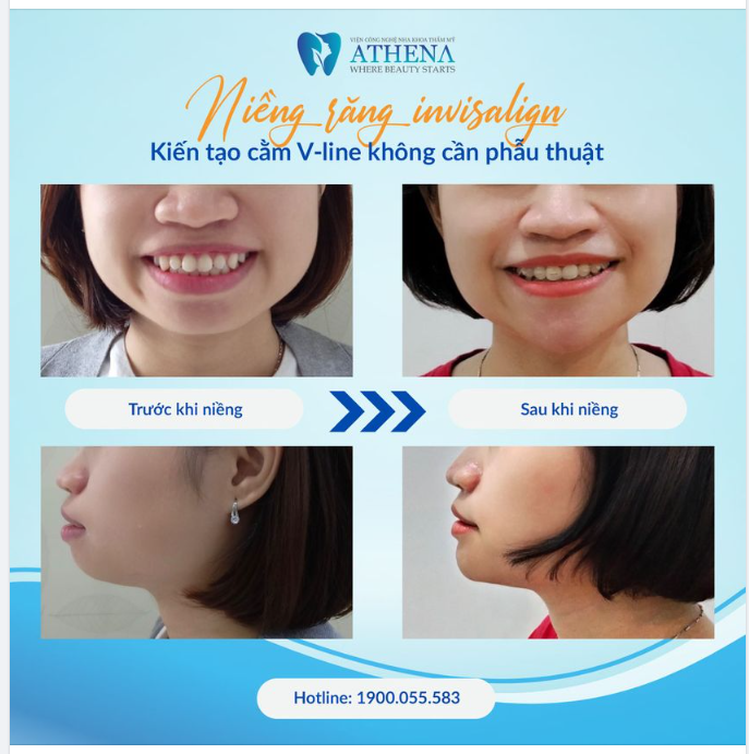 Đố bạn tìm ra 3 điểm khác biệt lớn nhất của khách hàng trước và sau khi niềng răng tại ATHENA!