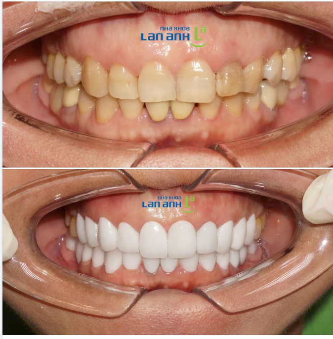 Khoác một lớp áo mới cho men răng, lấy lại sự trẻ trung và hàm răng trắng đều chỉ sau 2 lần hẹn
