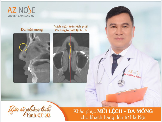 Xử lý tình trạng mũi l.ệch - da m.ỏng cho khách hàng 8X đến từ Hà Nội