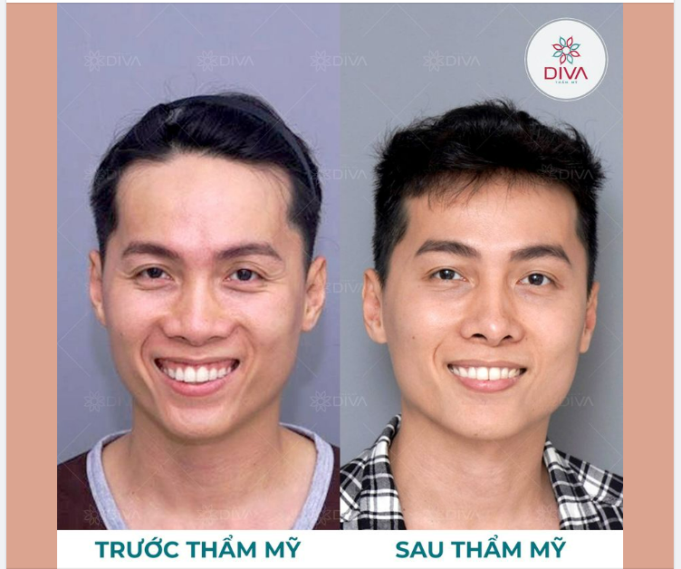 MẶT GẦY XƯƠNG, HỐC HÁC, GIÀ NUA SAU THẨM MỸ THAY ĐỔI RA SAO?