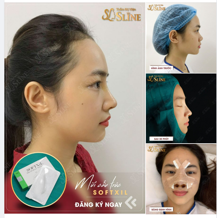 Nâng mũi  Chỉ từ 14tr. Chương trình áp dụng cho 10 suất đăng ký sớm nhất trong tháng này.
