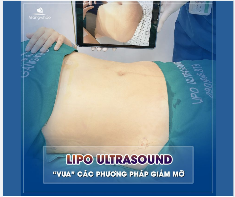 LIPO ULTRASOUND - VUA CÁC LOẠI PHƯƠNG PHÁP GIẢM MỠ