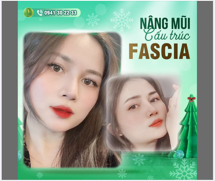 NÂNG MŨI CẤU TRÚC FASCIA - SIÊU ƯU ĐÃI DỊP LỄ