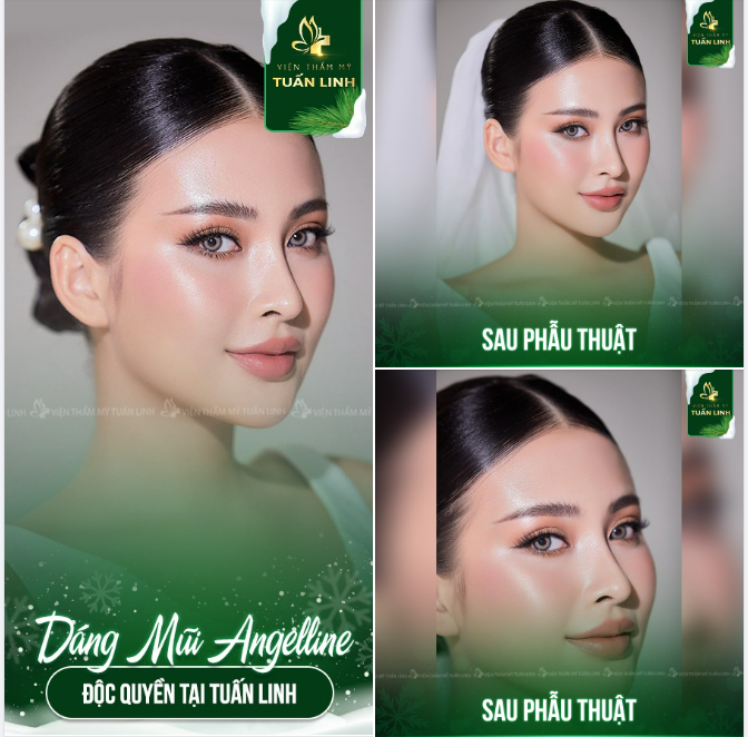 Dáng mũi Angel Line độc quyền tại Tuấn Linh