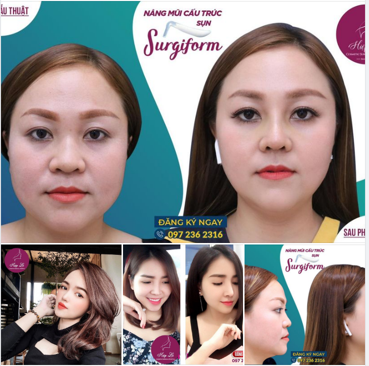 SỞ HỮU THẦN THÁI NGÚT NGÀN VỚI NÂNG MŨI SURGIFORM