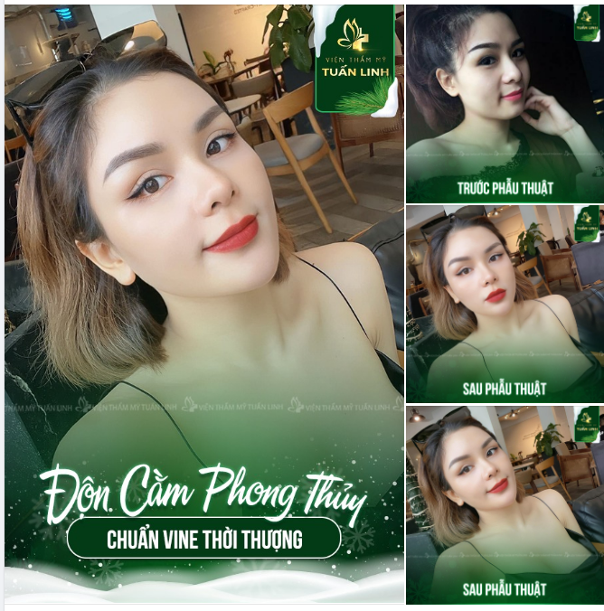 " Giật mình " nhìn lại nhan sắc thay đổi 360 độ chỉ sau một chút thay đổi nhỏ với Độn cằm vline giá quá hời chỉ 1X triệu ( X siêu nhỏ) thôi nhé