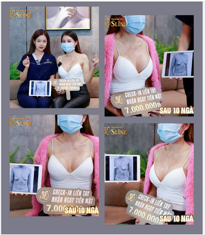 Nâng ngực sau 10 ngày.
