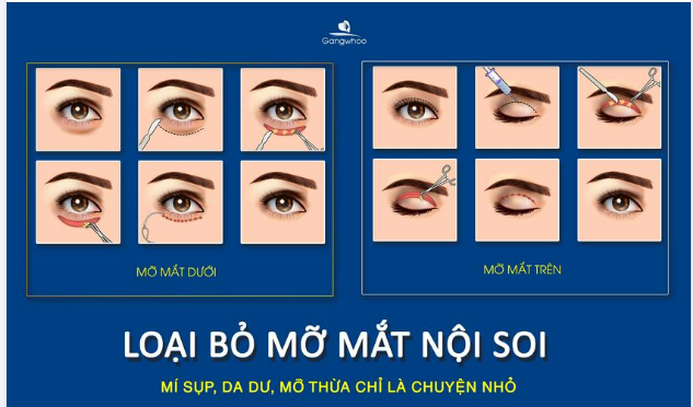 DA DƯ MỠ THỬA CHỈ LÀ CHUYỆN NHỎ VỚI MỠ MẮT NỘI SOI