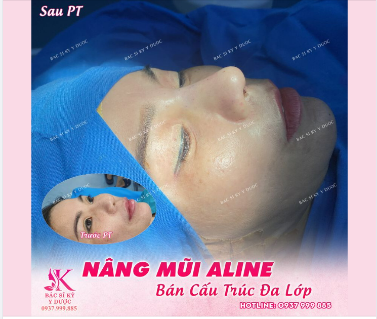 Mũi của bạn sửa bị lỗi hãy đến Bác Sĩ Kỳ Y Dược