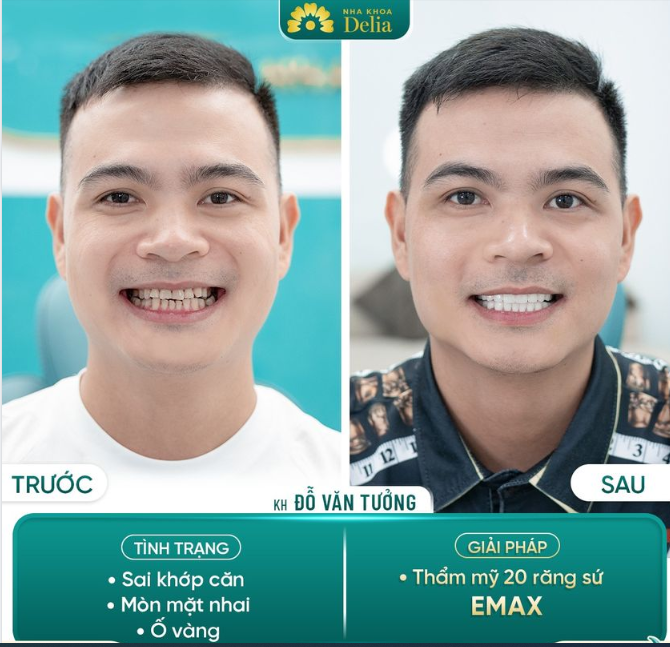 Khắc phục 100% khuyết điểm hàm răng chỉ sau 02 lần hẹn.