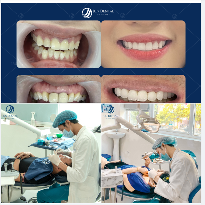 Đầu tháng đem đến nụ cười tự tin bừng sáng cho các khách hàng là đội ngũ Jun Dental thấy vui lắm rồi!