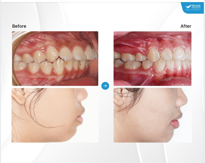 Ca lâm sàng Niềng răng chỉnh hô, hoàn thành sau 18 tháng