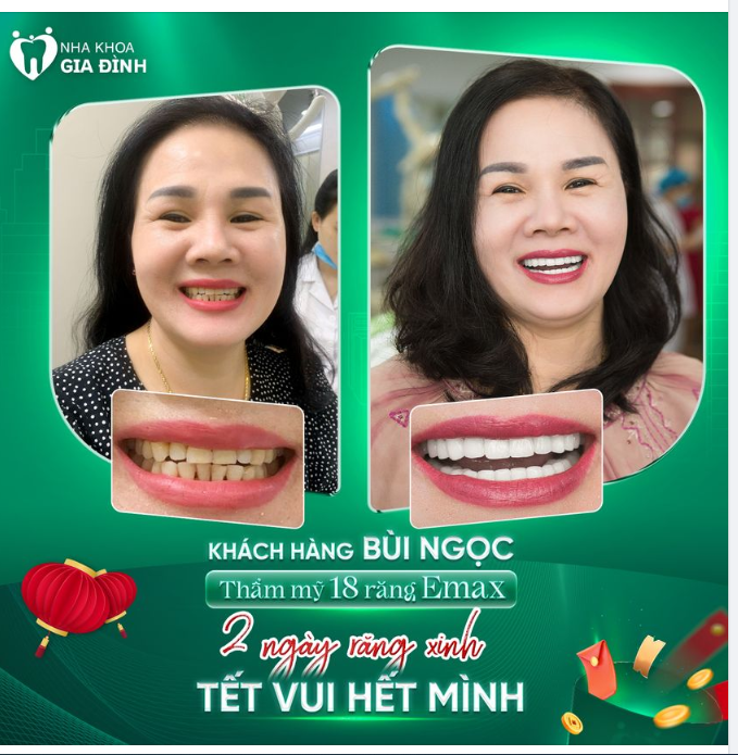 TRẺ HƠN NHIỀU TUỔI SAU KHI SỞ HỮU NỤ CƯỜI RẠNG RỠ, NỔI BẬT