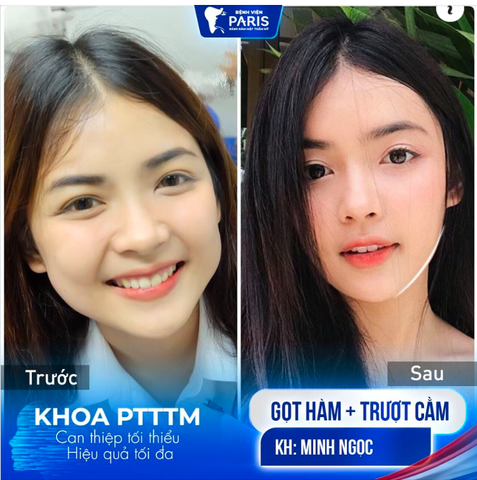 Công nghệ 3D Face Master   Lành thương nhanh gấp 3 lần