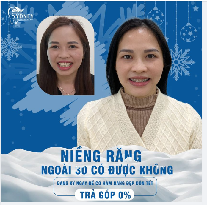 Niềng răng ngoài 30 có được không?