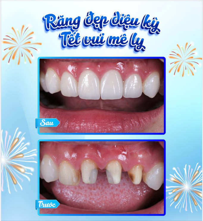 Mến chúc chị T với hàm răng trắng sáng, nụ cười tự tin sẽ có một năm mới bình an, thuận lợi trong cuộc sống và công việc.