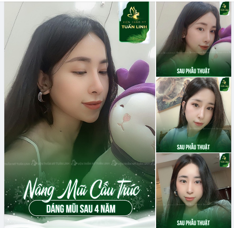 Cận cảnh dáng mũi sau 4 năm nâng mũi tại Tuấn Linh