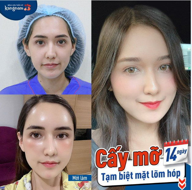Cấy mỡ vừa xinh lại trẻ ra sau 14 ngày